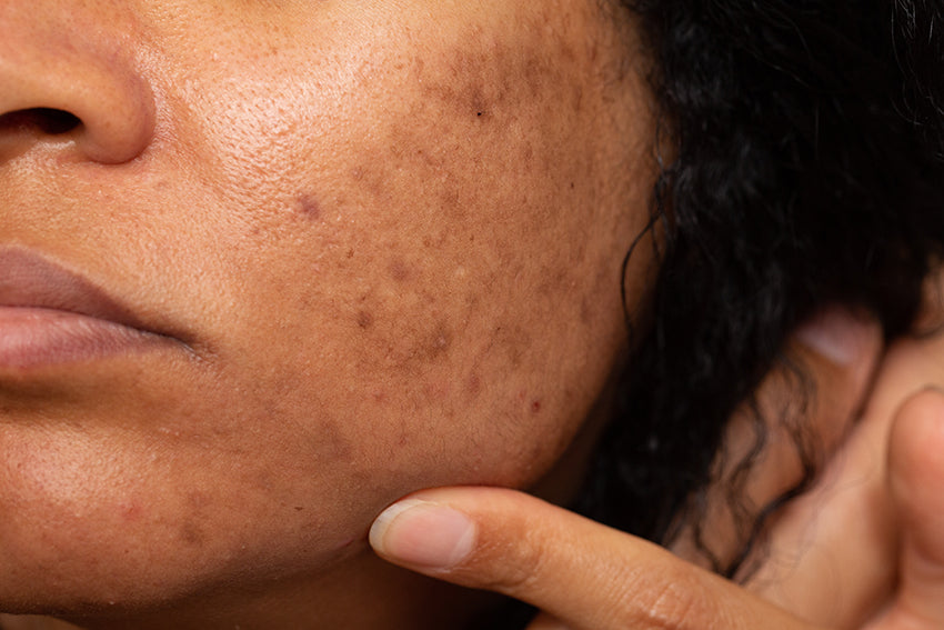 Can Vitamin C Improve the Look of Dark Spots?