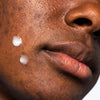 Woman with 2 small dots of USRX Clear Complexion Acne Serum + Spot Treatment on face